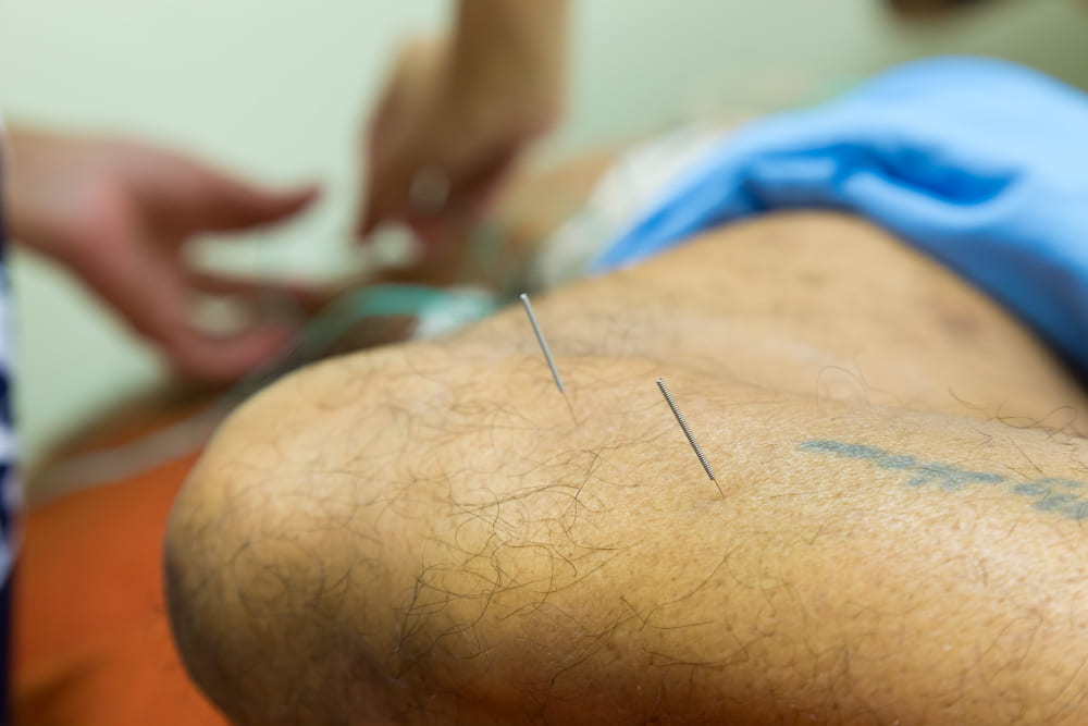 acupuntura-recomendada.jpg