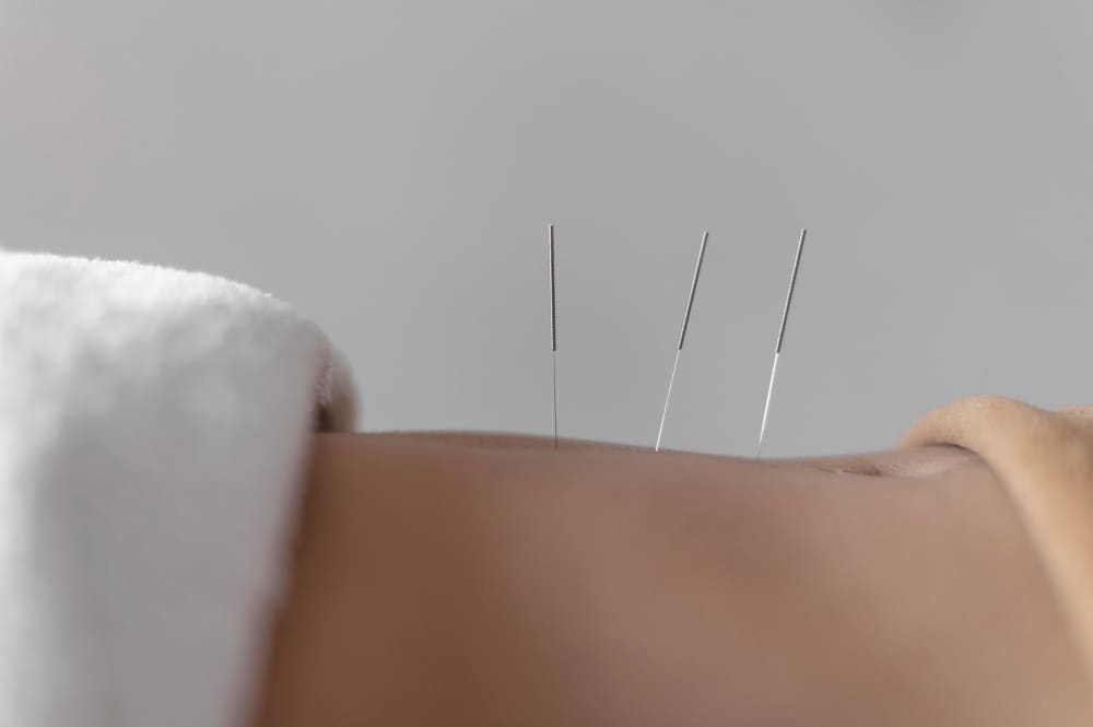 servicio-de-acupuntura-privado.jpg