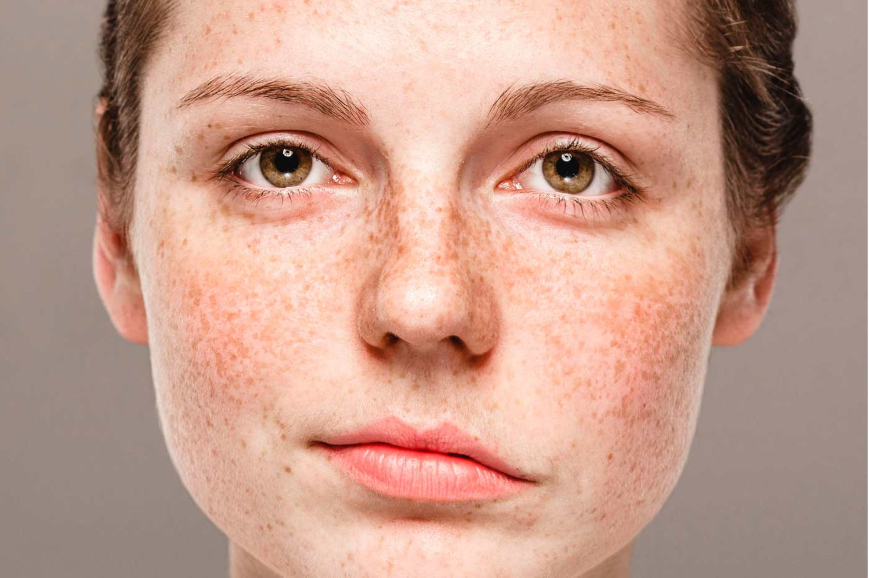 Acupuntura para parálisis facial